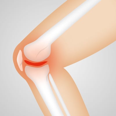 Arthrose vorbeugen und behandeln